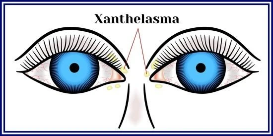 210906142144-xanthelasma-550x274.jpg