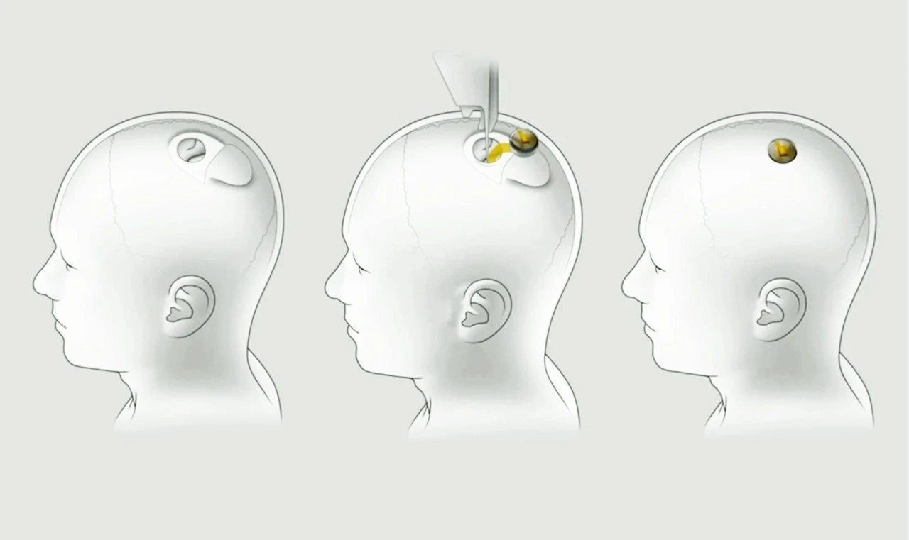 220207173553-neuralink-installation-1280x761.jpg