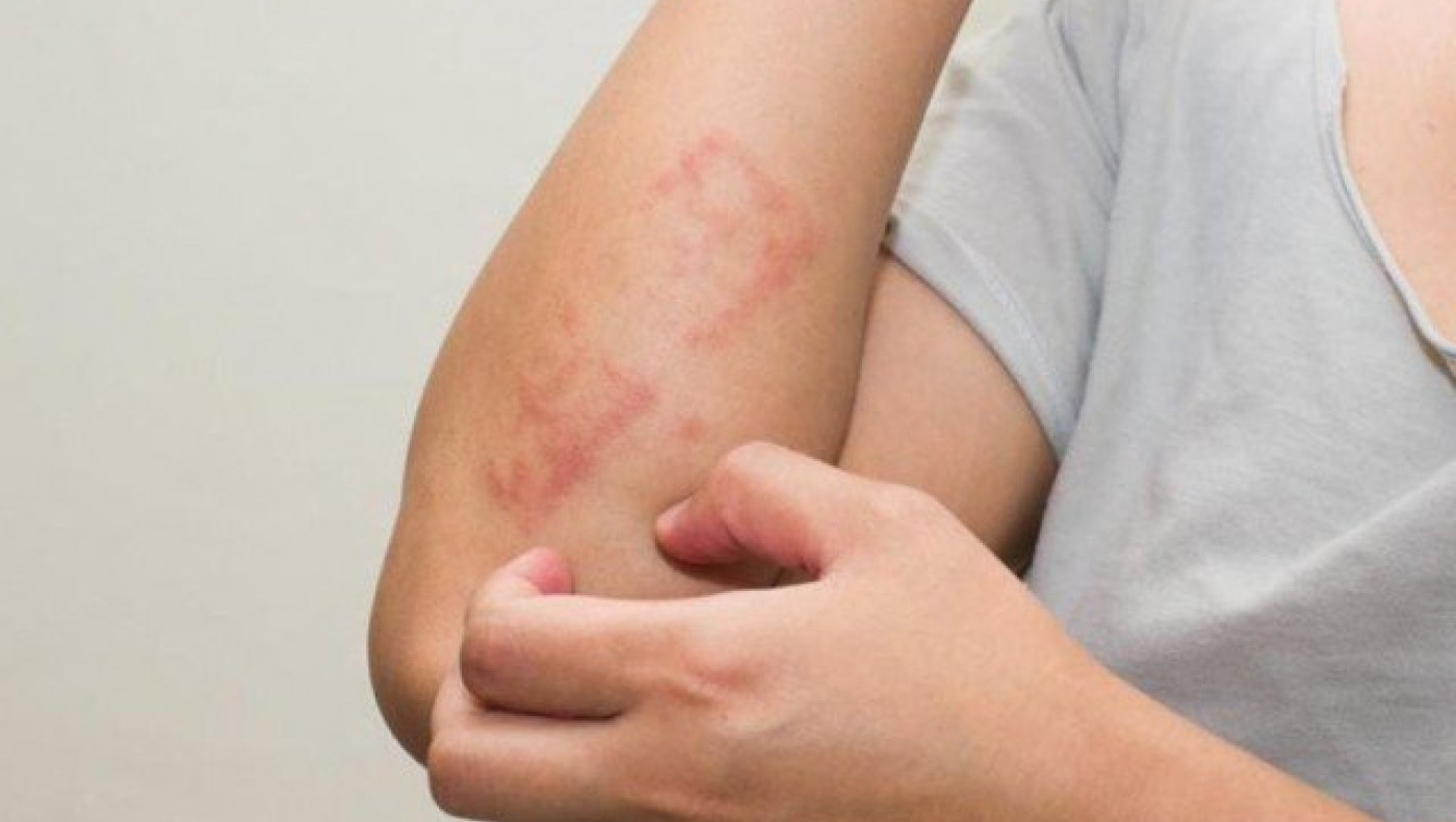 Θεσσαλονίκη: Διήμερο λουκέτο σε σχολείο λόγω     ψώρας