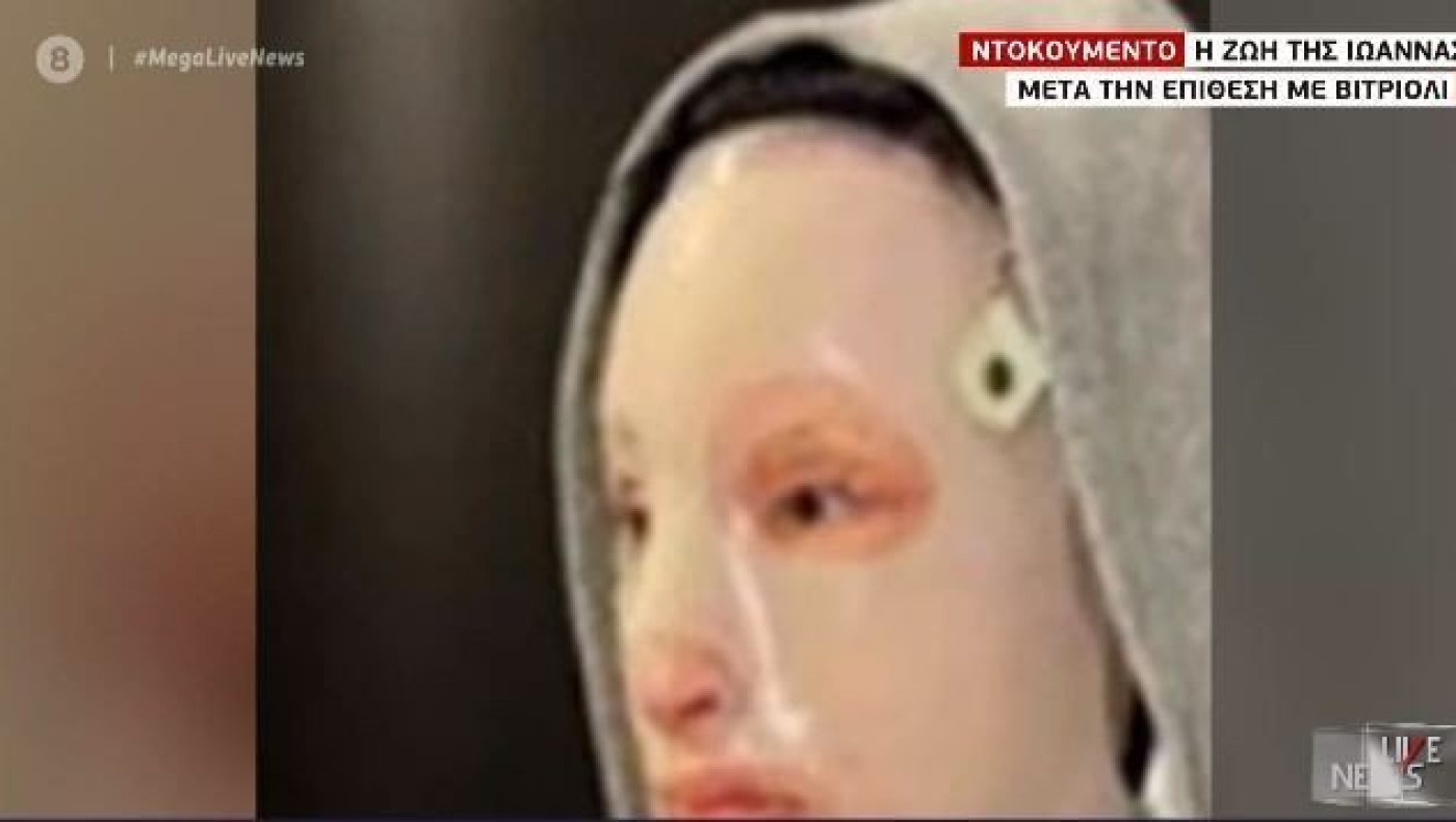 Επίθεση με βιτριόλι: Σοκάρει η φωτογραφία της Ιωάννας δέκα μήνες μετά