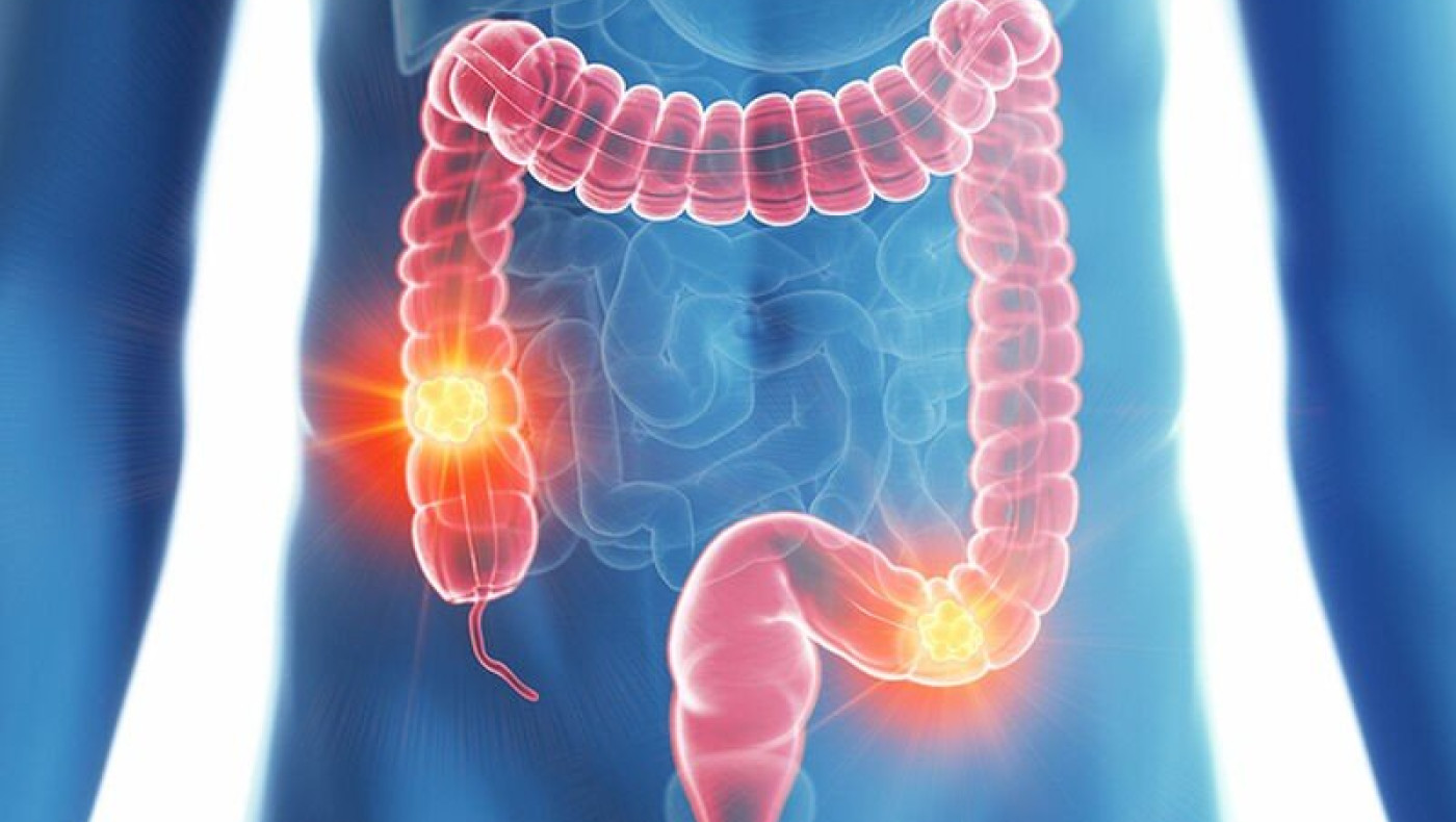 Καρκίνος Παχέος Εντέρου: Μειώστε τον κίνδυνο τρώγοντας αυτό δυο φορές την εβδομάδα