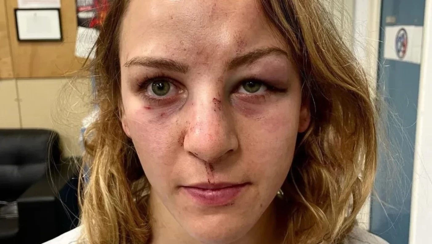 Ολυμπιονίκης παραμορφωμένη από τα χτυπήματα του συντρόφου της -Ανέβασε φωτογραφία