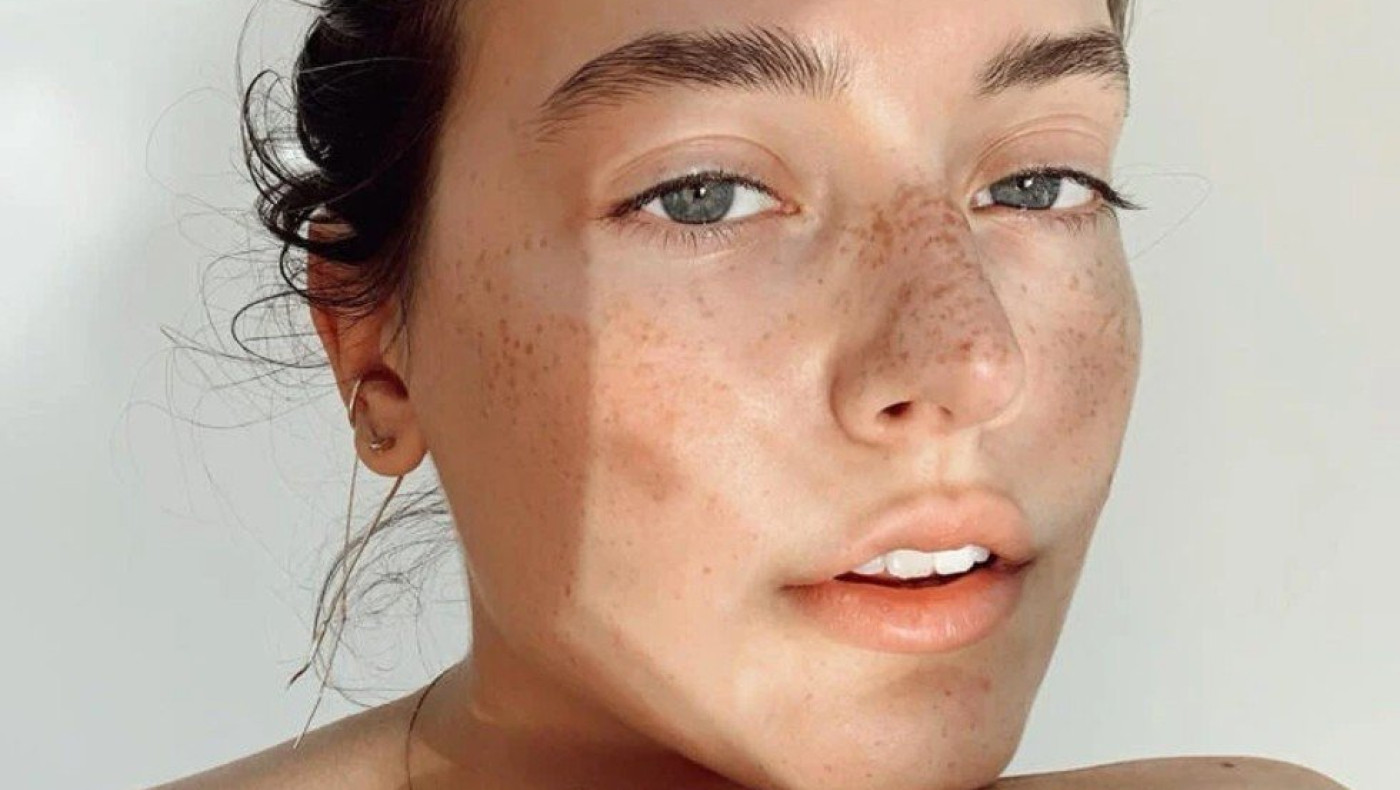 Όσα πρέπει να γνωρίζετε για την κυστική ακμή και την αντιμετώπισή της