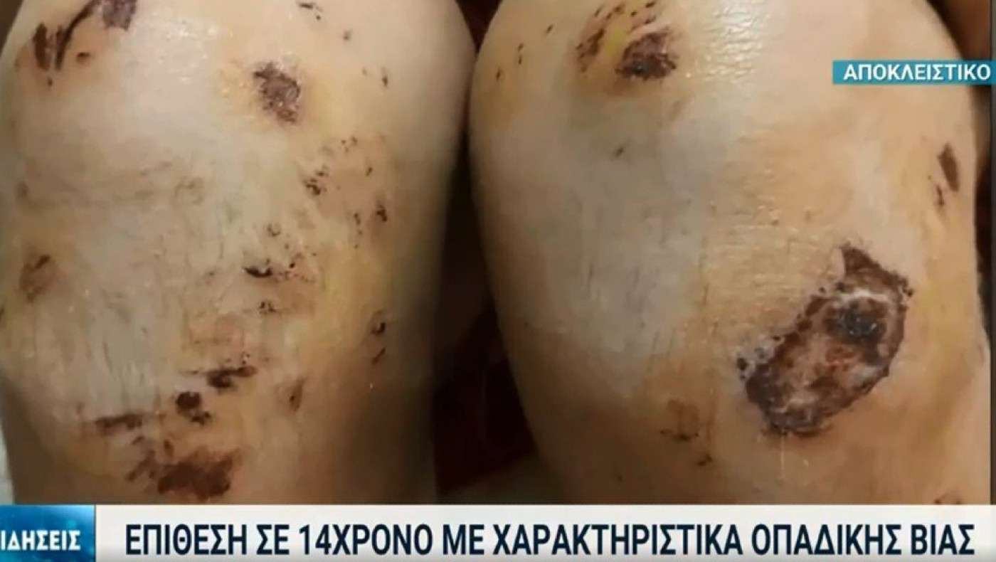 Οπαδικό... αμόκ στη Θεσσαλονίκη: Χτυπούσαν με μανία 14χρονο στην παραλία