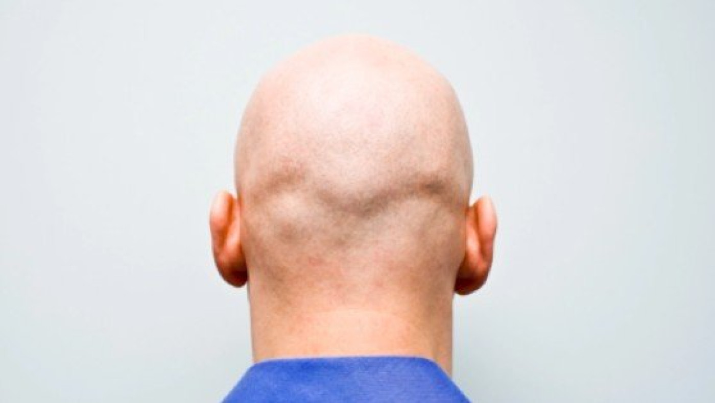 Απόφαση σταθμός για την φαλάκρα στην Βρετανία!