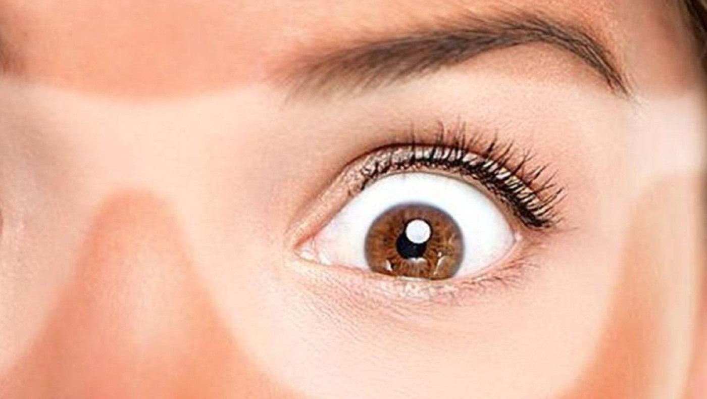 Κάηκα από τον ήλιο: Πώς το αντιμετωπίζω γρήγορα