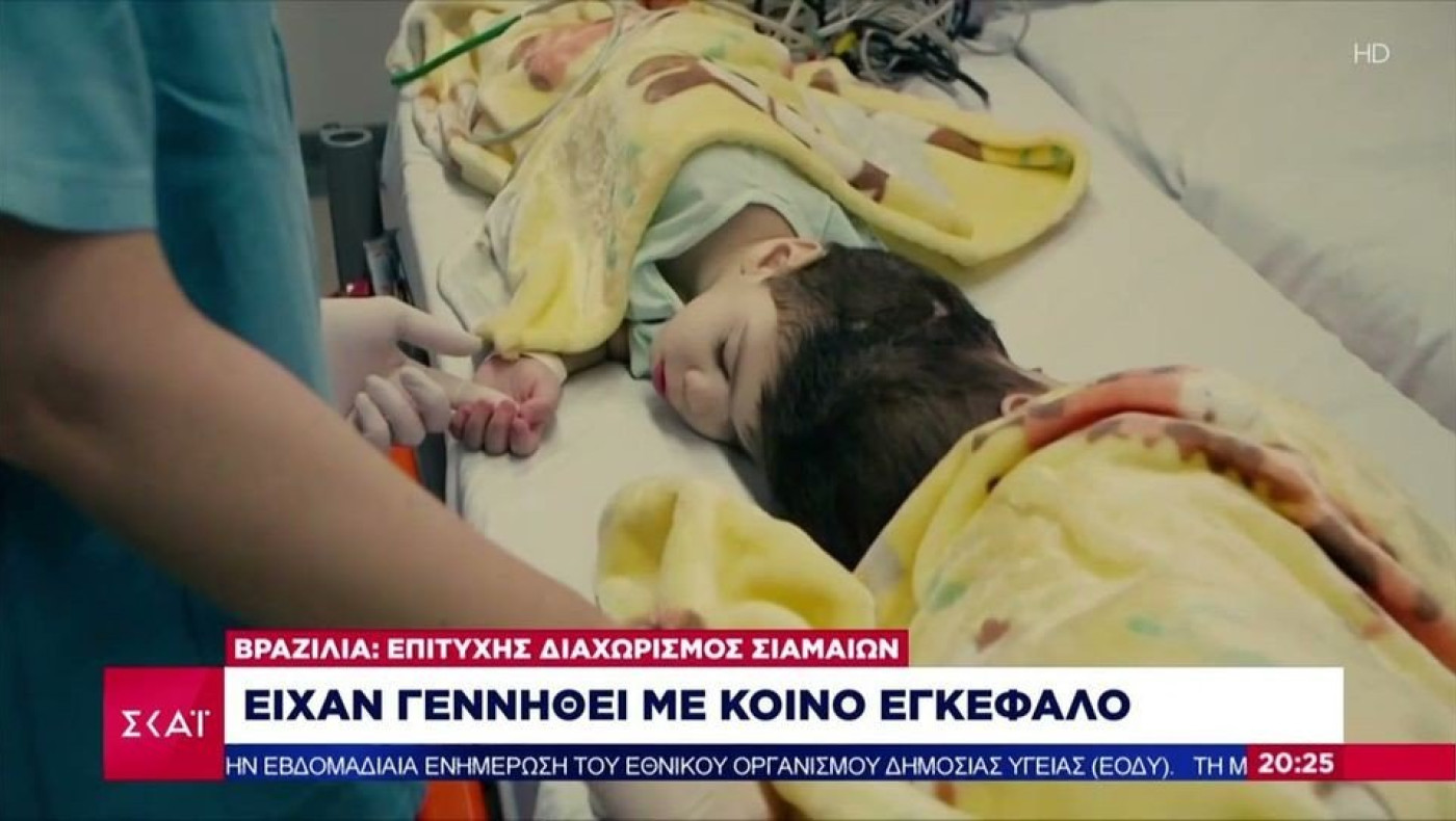 Διαχώρισαν σιαμαία ενωμένα στο κεφάλι μετά από 7 χειρουργεία!