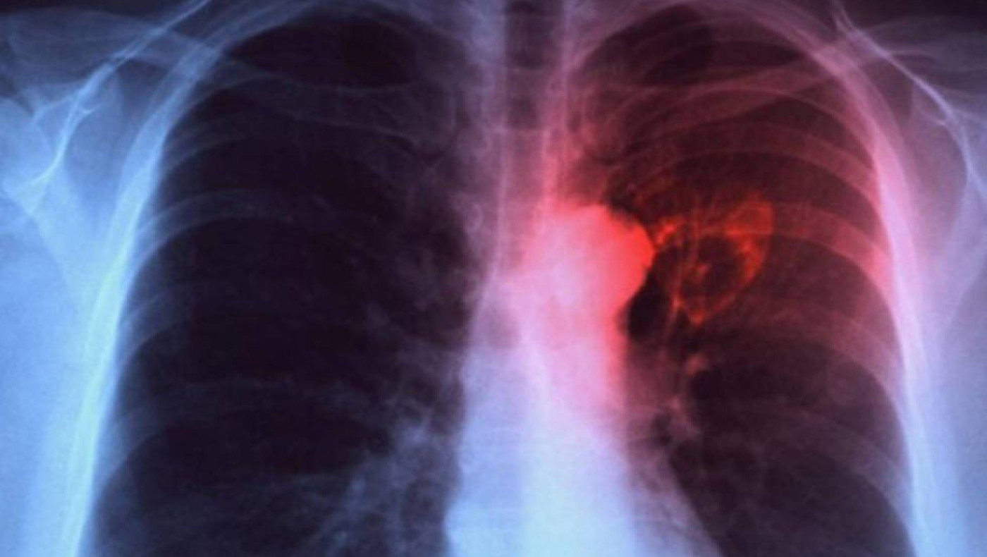 Φυματίωση: «Συναγερμός» από τον ΠΟΥ, η νόσος επιστρέφει