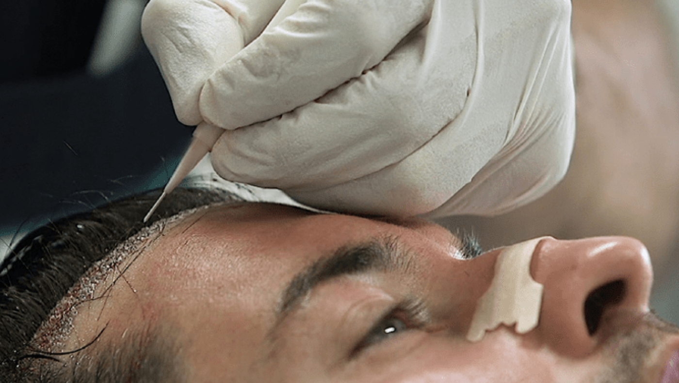 Έχεις τριχόπτωση; Έχουμε τη λύση