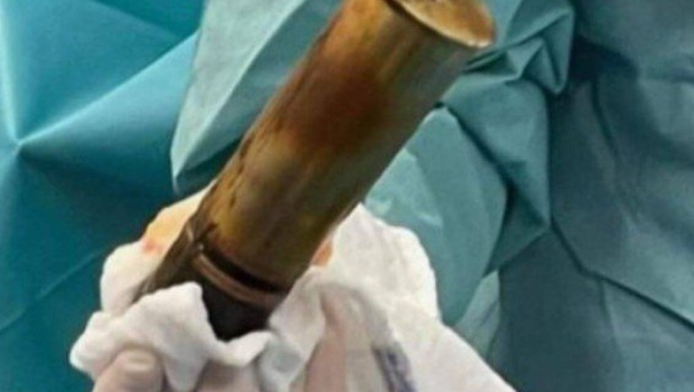 Γαλλία: Είχε οβίδα του Α’ Παγκοσμίου στον πρωκτό του και πήγε στο νοσοκομείο!