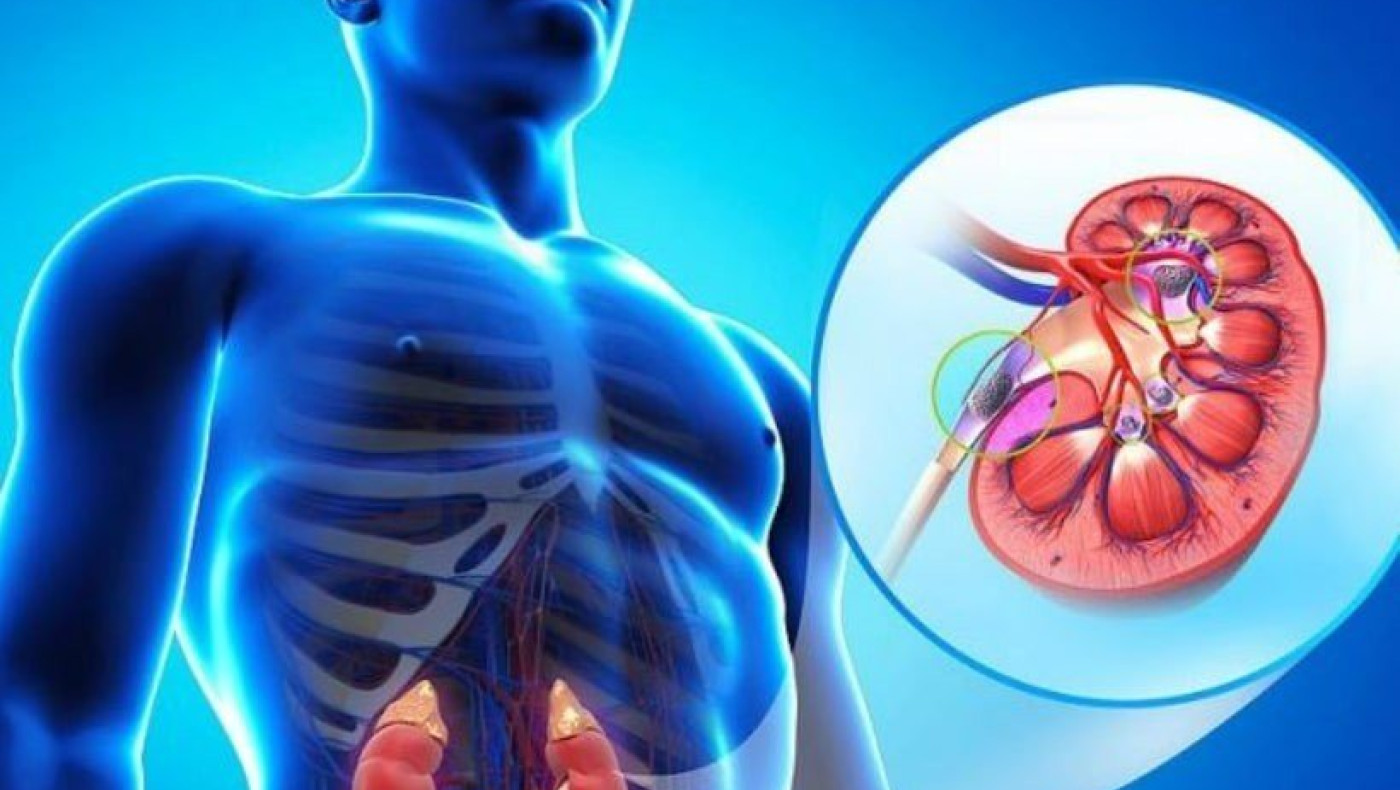 Πέτρες στα νεφρά: Το μυστικό για να αποφύγουμε τις υποτροπές