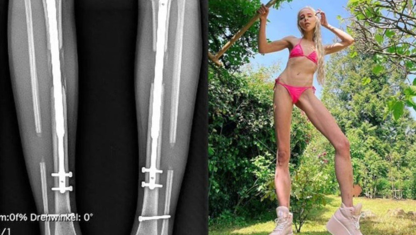 Μοντέλο ξόδεψε 149.000 ευρώ για να μεγαλώσει τα… πόδια της και ψήλωσε 14 εκατοστά