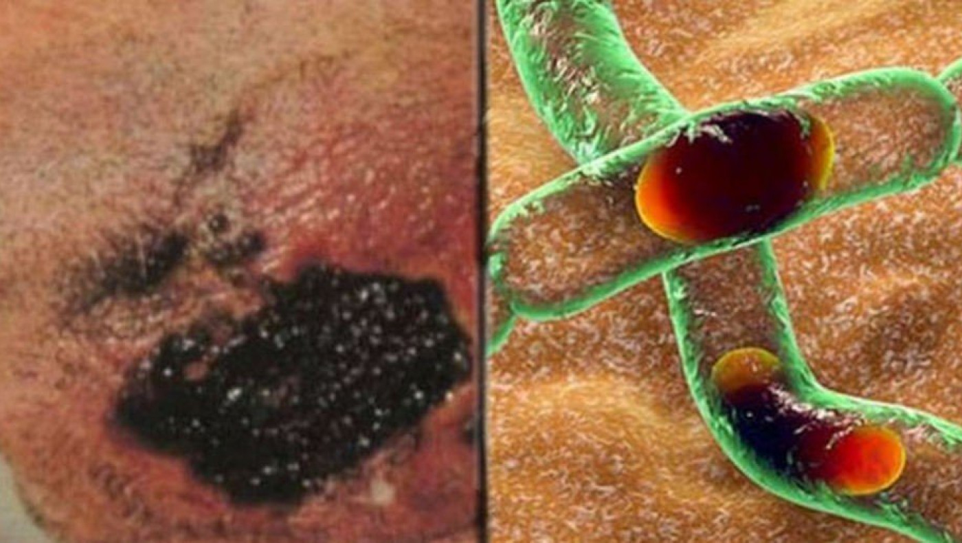 Τι είναι η νόσος του άνθρακα-Γιατί λέγεται «μαύρη κατάρα»