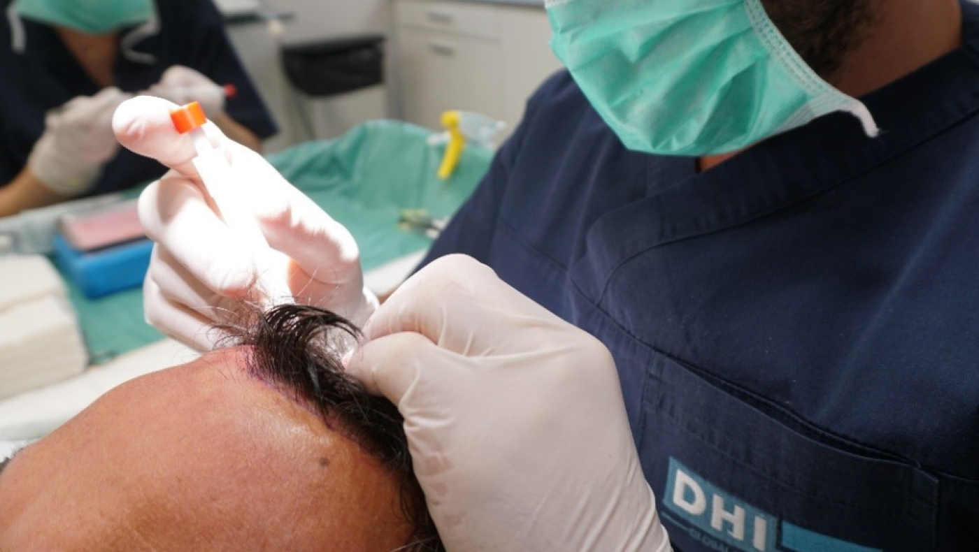 Μεταμόσχευση μαλλιών χωρίς κούρεμα!