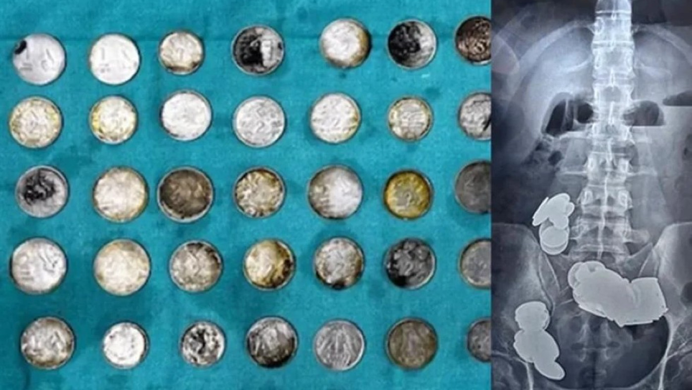 Κατάπιε κέρματα και μαγνήτες για να «χτίσει» σώμα