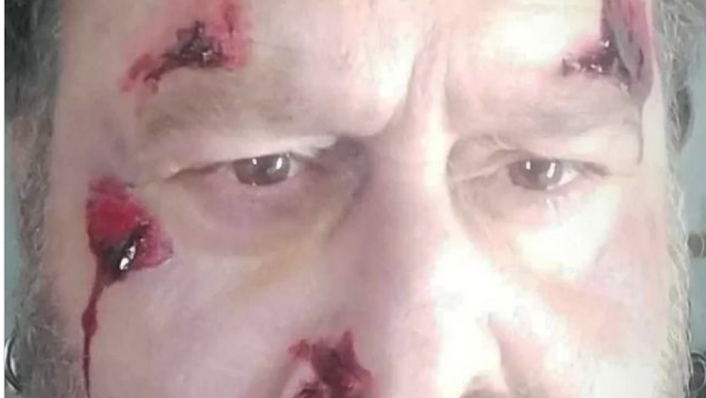 Θύμα τροχαίου ο ηθοποιός Κωστής Σαββιδάκης-Η ανάρτηση της οργής με τα τραύματα: «Σκοτώνετε κόσμο»