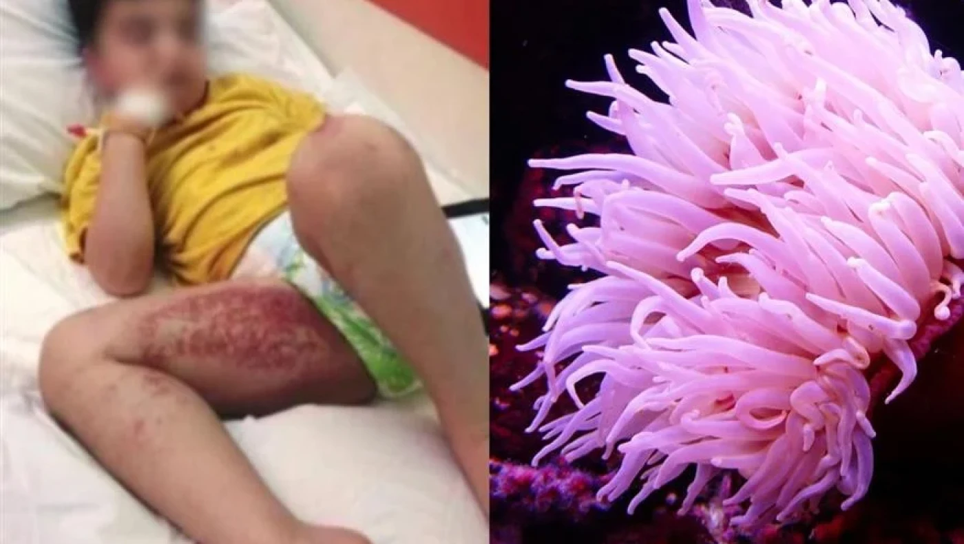 Ναύπλιο: Θαλάσσιες ανεμώνες «επιτέθηκαν» σε παιδί - Οδηγίες προστασίας