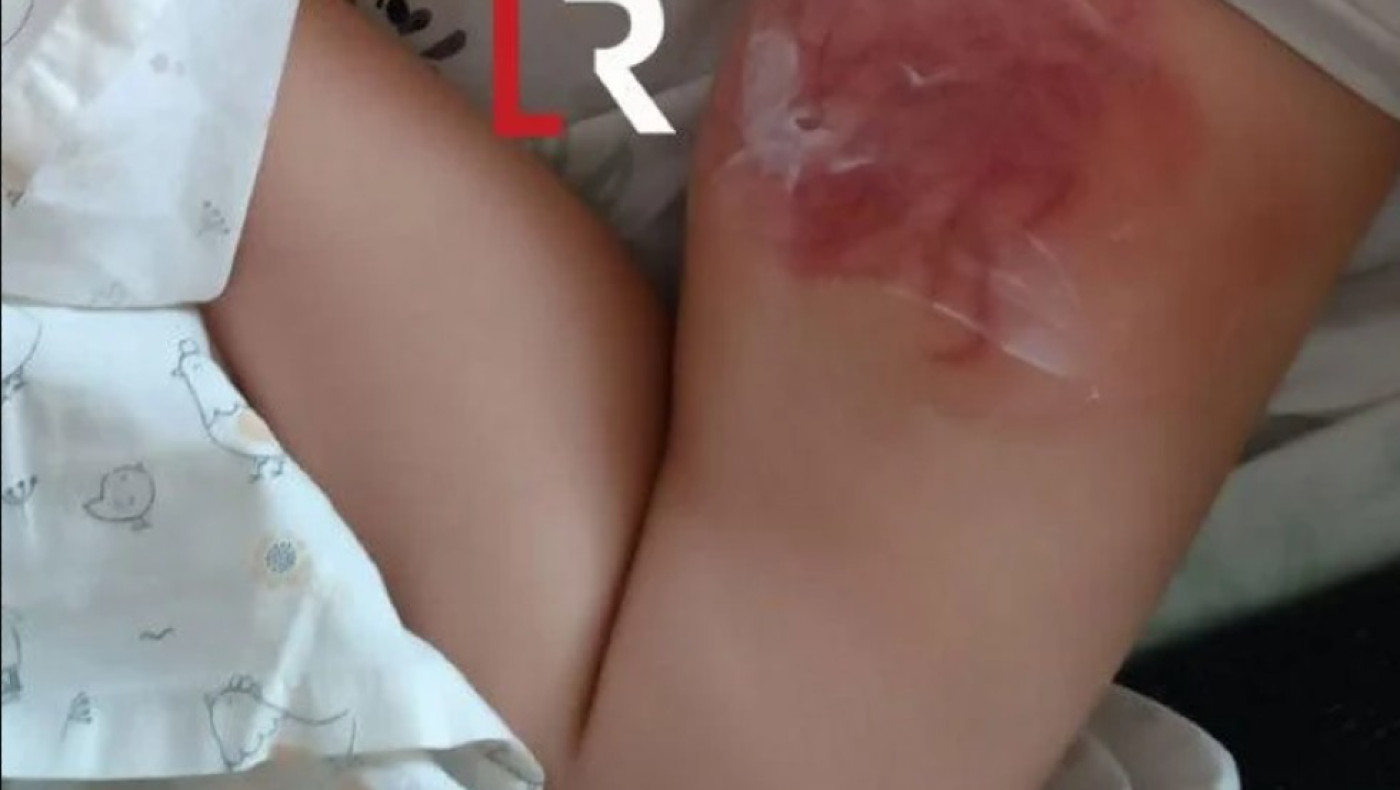 Φθιώτιδα: Θαλάσσια ανεμώνη τσίμπησε 4χρονη σε παραλία - Η θεραπεία θα πάρει 6 μήνες