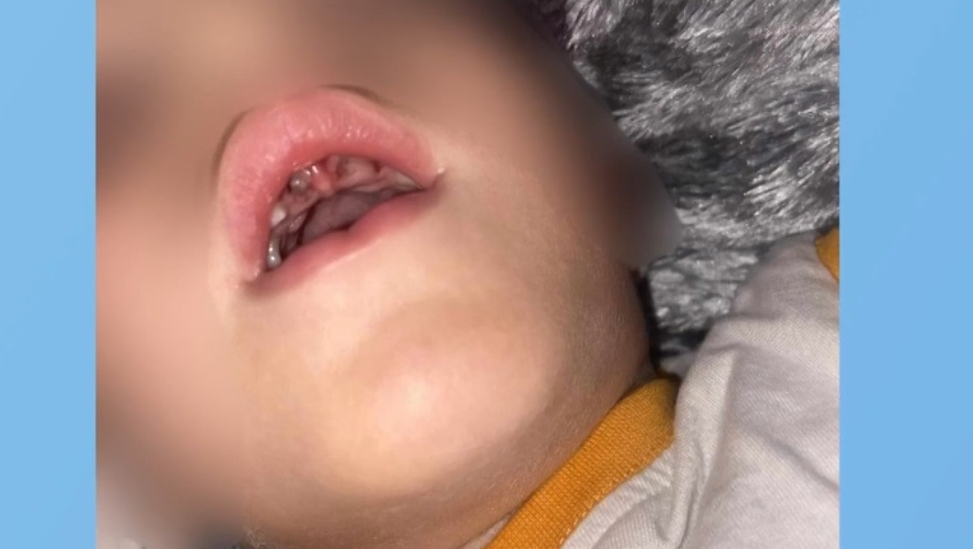 Του έσπασαν τα δόντια και είπαν ότι... σκόνταψε - Τριετής η διάρκεια θεραπείας