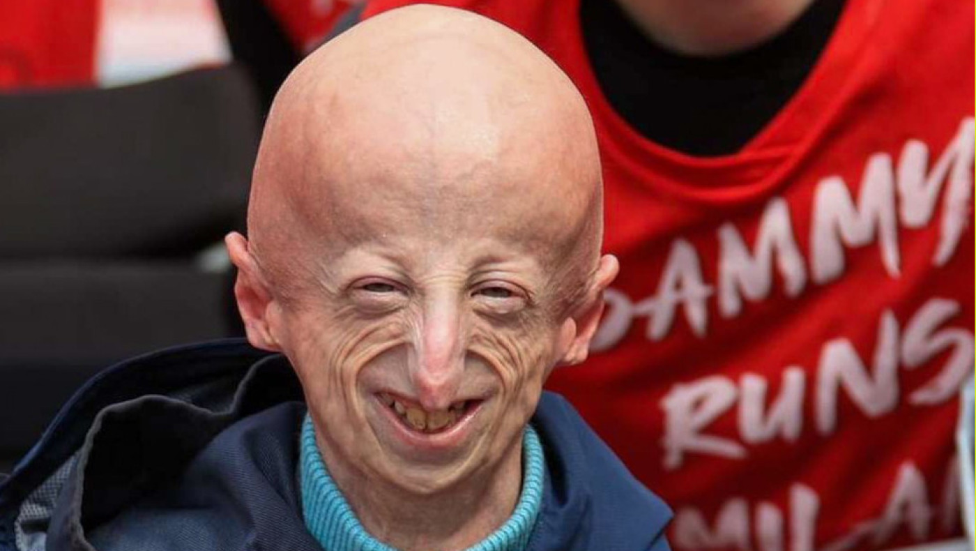 Πέθανε ο Σάμι Μπάσο- Έπασχε από το σύνδρομο πρόωρης γήρανσης