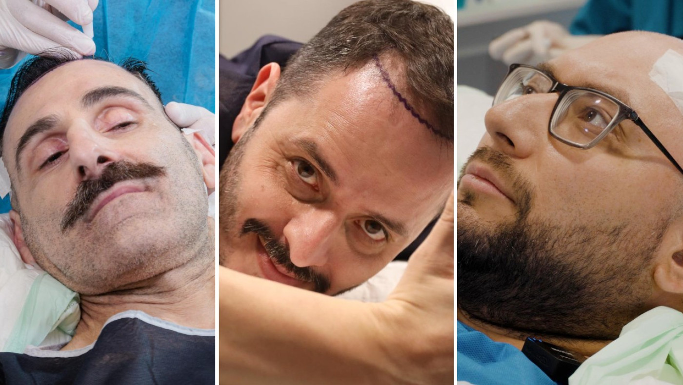 Γιατί Τσουβέλας, Μαλιάτσης και Κοψιδάς επέλεξαν τη Seneca για τη μεταμόσχευση μαλλιών