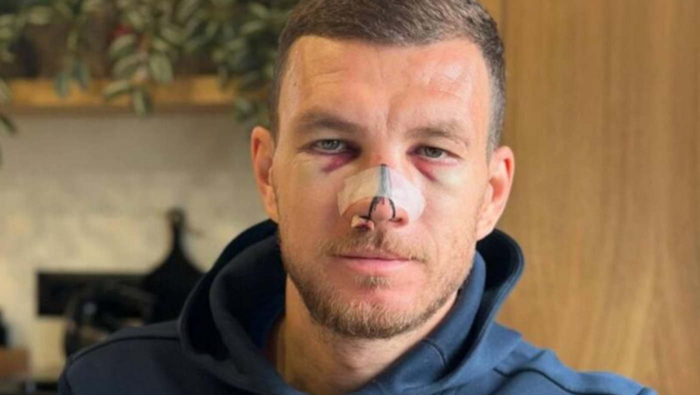 Έντιν Τζέκο: Φωτογραφήθηκε με τα σημάδια της κλωτσιάς στο πρόσωπο