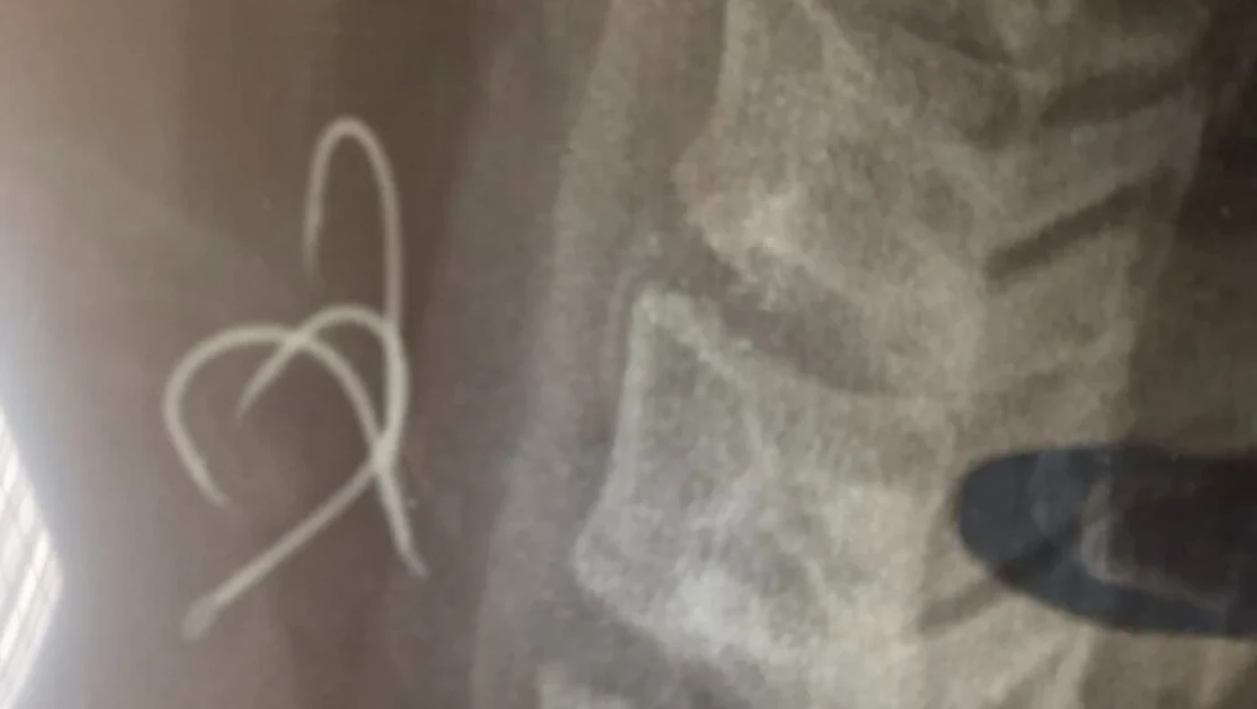 Έφαγε χταπόδι με... αγκίστρι