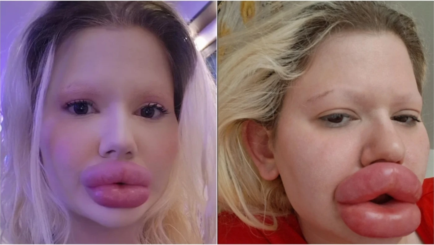 Η γυναίκα με τα μεγαλύτερα χείλη στον κόσμο: Το ποσό-«μαμούθ» που δαπάνησε για να τα αποκτήσει