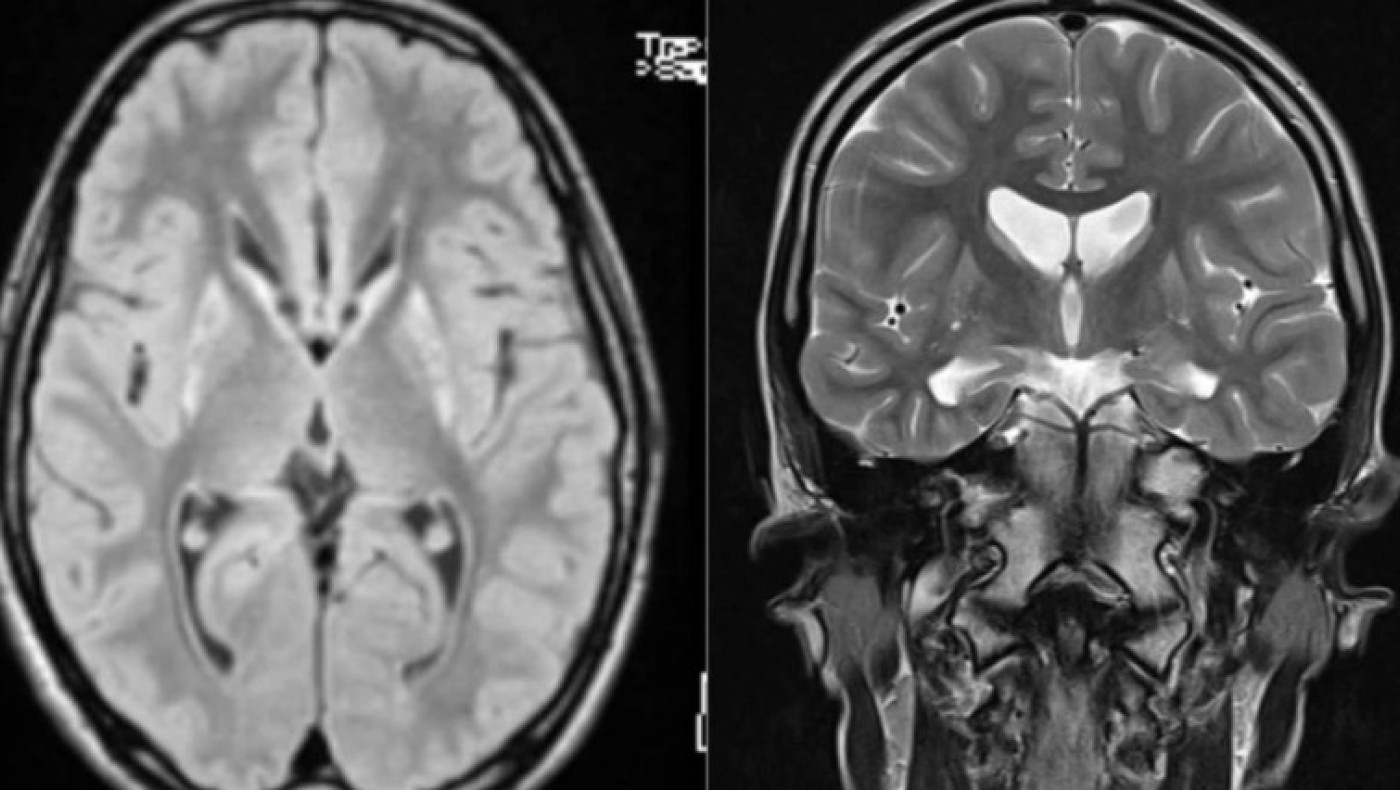 Πρωτοποριακή θεραπεία για τη νόσο του Χάντινγκτον επιβραδύνει την εξέλιξη της ασθένειας κατά 75%