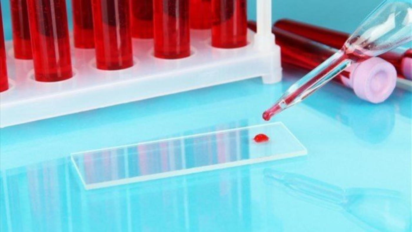 Εξέταση αίματος προβλέπει την ανταπόκριση στην αντικαρκινική θεραπεία