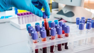 Τα εργαστηριακά ευρήματα που προκαλούν ανησυχία για τον κορωνοϊό