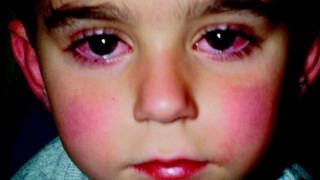 Νόσος Kawasaki: Τι είναι και ποιες οι επιπλοκές της