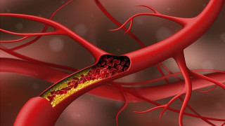 Νέα όρια για τη χοληστερόλη: Τι αλλάζει στις οδηγίες για την LDL