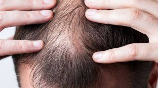 Φάρμακο για την αρθρίτιδα θεραπεύει την αλωπεκία