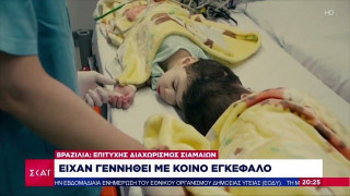 Διαχώρισαν σιαμαία ενωμένα στο κεφάλι μετά από 7 χειρουργεία!