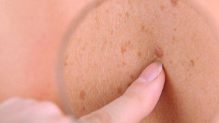 Θεσσαλονίκη: Δωρεάν εξετάσεις για τον καρκίνο του δέρματος