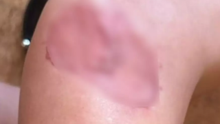 Γνωστή influencer πήγε για πλαστική στήθους και παραλίγο να της ακρωτηριάσουν το πόδι