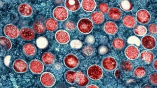 Ευλογιά των πιθήκων: Σε ετοιμότητα οι υγειονομικές αρχές