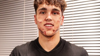 Μπαρτσελόνα: Σοκαριστικές εικόνες του Κουμπαρσί μετά την κλωτσιά στο πρόσωπο