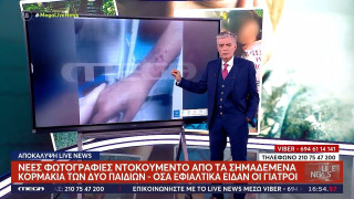 Λάρισα-Φωτογραφίες ΣΟΚ: Τα εγκαύματα από τα τσιγάρα στα κορμιά των δύο ανηλίκων