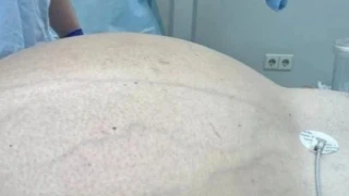 Αφαίρεση γιγάντιου όγκου 60 κιλών από 50χρονο